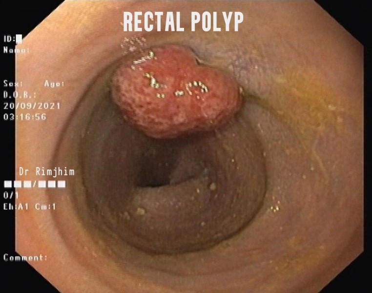 Rectal polyp problem in children