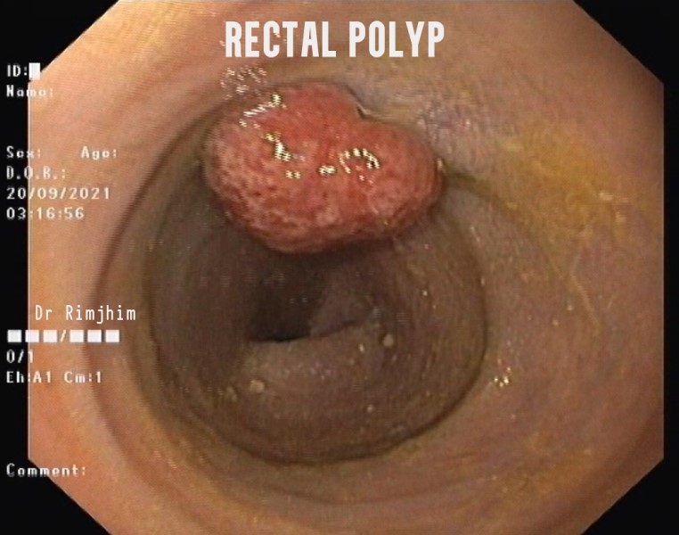 rectal polypectomy